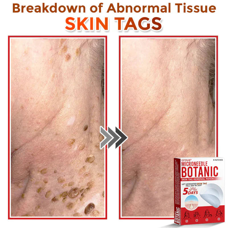 GFOUK® MicroNeedle Botanic Skin Tag Removal Patch