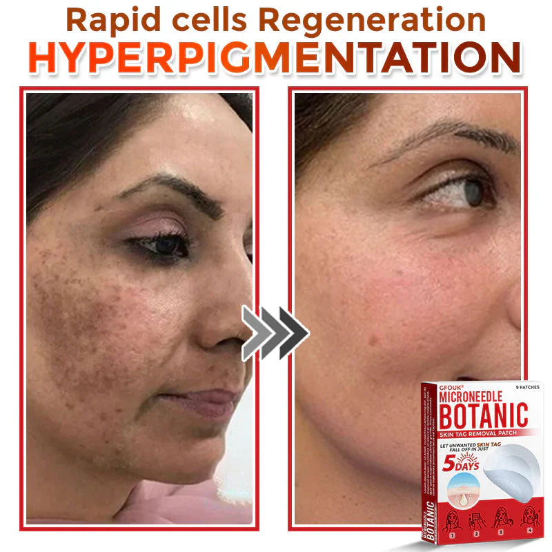 GFOUK® MicroNeedle Botanic Skin Tag Removal Patch