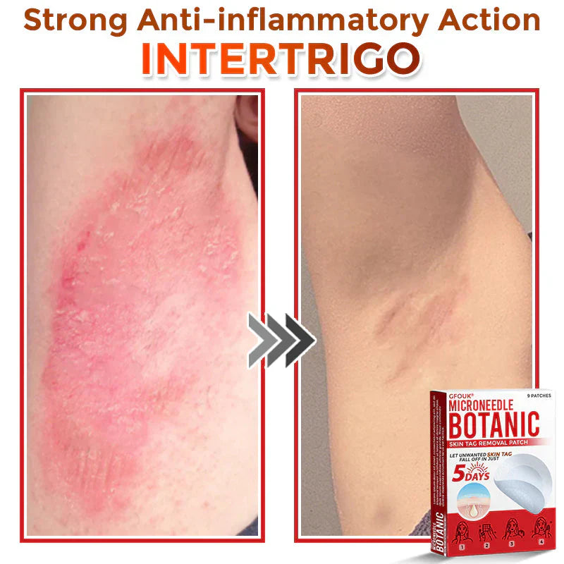 GFOUK® MicroNeedle Botanic Skin Tag Removal Patch